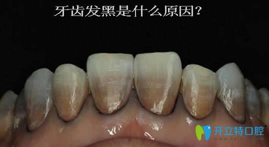 一次性告訴你:牙齒發(fā)黑是什么原因？可能與蛀牙無關(guān)