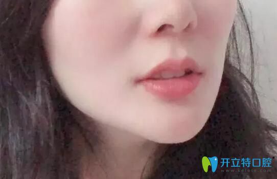 德韓口腔下牙套后照片