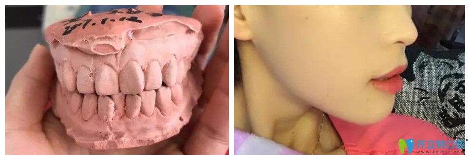 這不僅有上牙外翻圖片，還有上牙外翻矯正的方法及價格