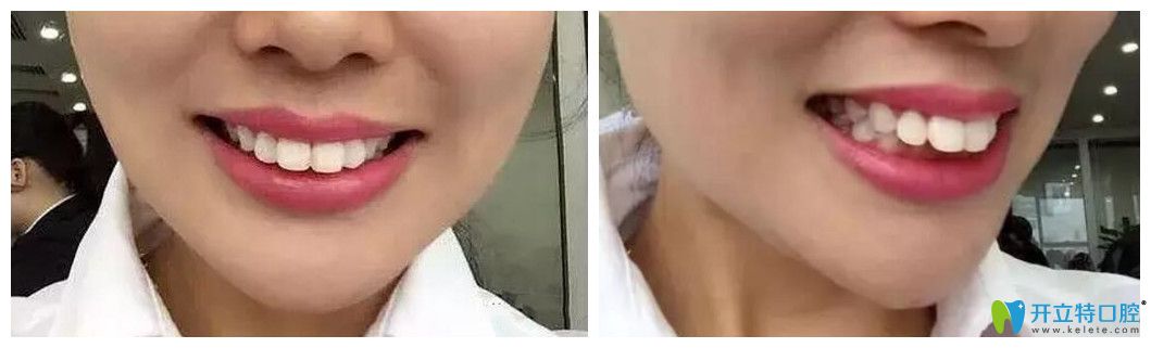 上牙外翻情況比較嚴重
