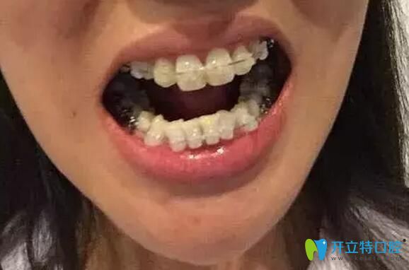 南昌德韓口腔齙牙矯正中