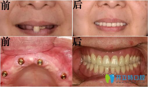 東莞好佰年口腔allon6全口種植牙真實(shí)案例