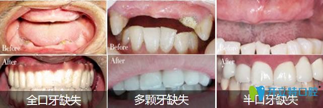 深圳弘和全口/半口種植牙對比圖