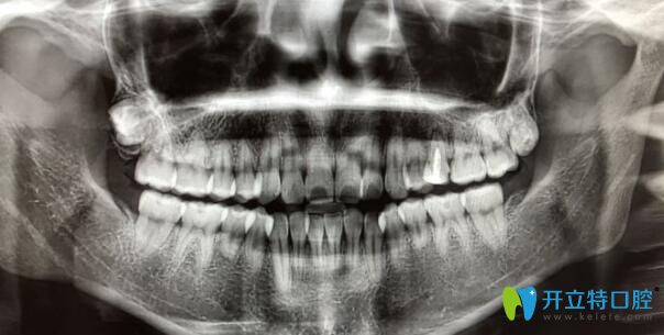 牙根短做正畸5個(gè)月自白
