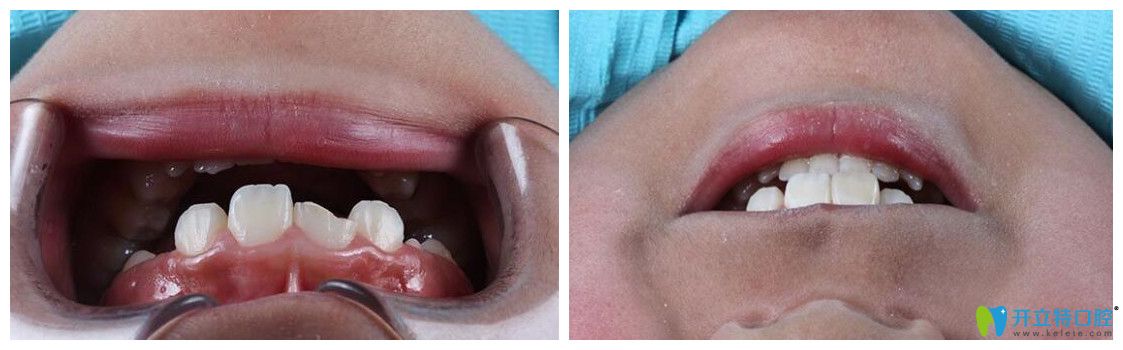 <!--<i data=20240703-sp></i>-->口腔展鵬牙齒修復案例