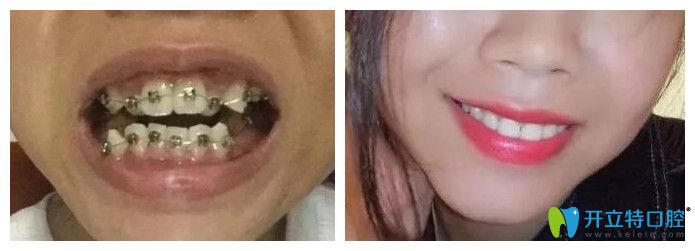 南昌德韓口腔牙齒矯正實(shí)例