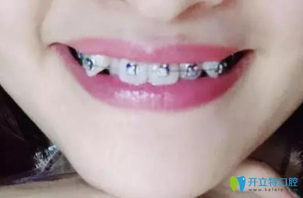 在<!--<i data=20240703-sp></i>-->做正畸戴牙套第1天