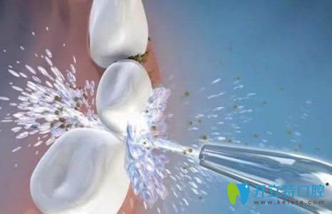 洗牙是否會(huì)造成牙隱裂呢