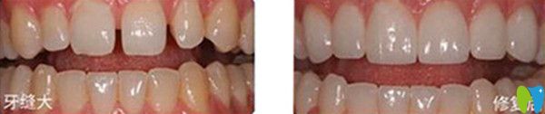 全瓷牙修復(fù)對比圖