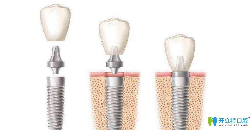 種植牙牙冠能換嗎？種植牙換個牙冠多少錢？