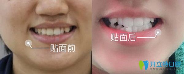 牙齒美容修復前后變化圖