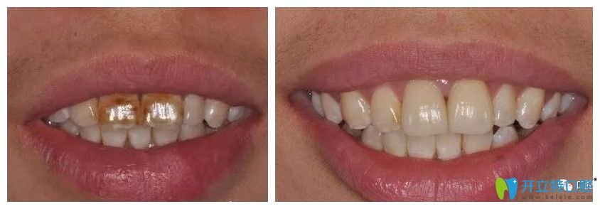 牙齒仿生美學(xué)修復(fù)前后對比效果圖 牙齒仿生美學(xué)修復(fù)前后對比效果圖