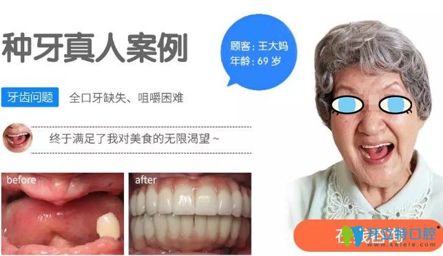 69歲王大媽在北極星做完全口種植牙對(duì)比效果