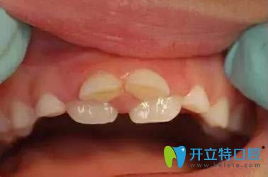 乳牙滯留造成的雙排牙癥狀圖