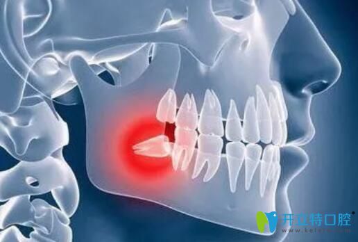 求解：我拔一顆智齒花了500多塊錢是不是被坑了？
