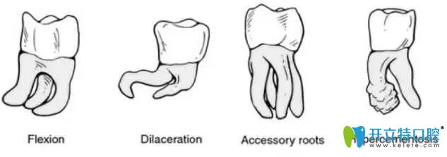 比較難拔的智齒圖片