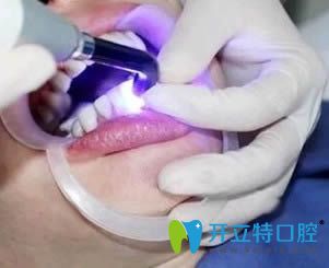 衡陽美萊口腔做全瓷牙貼面術中照 衡陽美萊口腔做全瓷牙貼面術中照