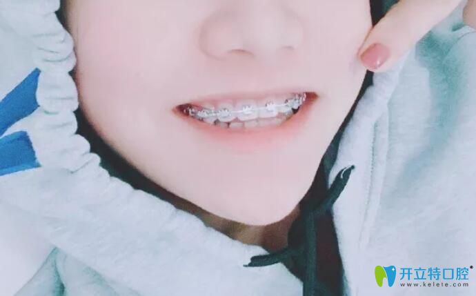 逸盛口腔戴牙套559天