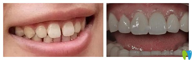 合肥崔勁松口腔崔瑩瑩醫(yī)生牙齒貼面案例 合肥崔勁松口腔崔瑩瑩醫(yī)生牙齒貼面案例
