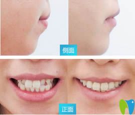 衡陽美萊口腔黃安醫(yī)生牙齒矯正效果對比圖 衡陽美萊口腔黃安醫(yī)生牙齒矯正效果對比圖