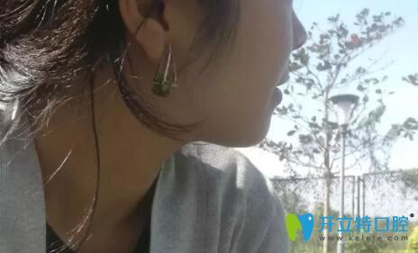 齙牙矯正下牙套后側(cè)面臉型圖片