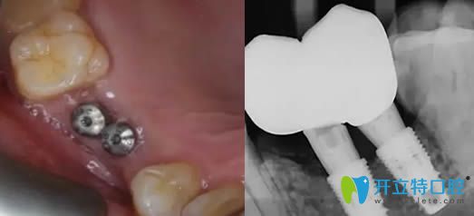 種植體種歪了的效果圖片