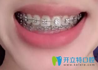 我在合肥崔勁松口腔做金屬托槽牙齒矯正13個月 我在合肥崔勁松口腔做金屬托槽牙齒矯正13個月