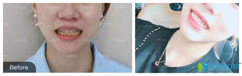 壹加壹黃牙全口瓷貼面美白前后效果對比 