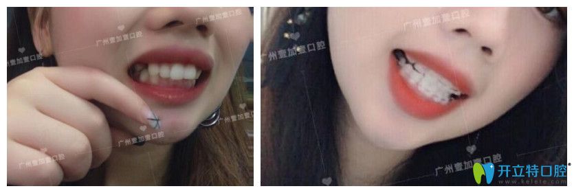 廣州壹加壹齙牙、牙齒擁擠不齊矯正案例效果前后對比照片