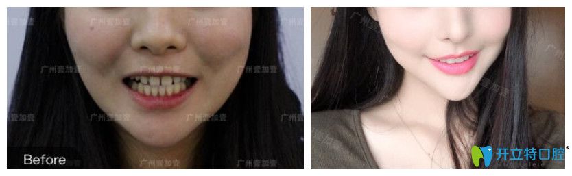 牙縫大采用美加瓷貼面修復對比圖