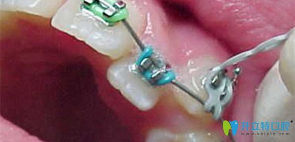 矯正中收縫的過(guò)程