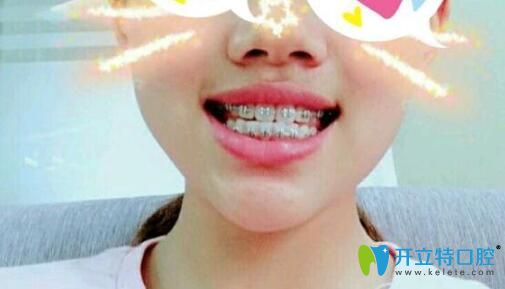 <!--<i data=20240703-sp></i>-->口腔矯正四個(gè)月牙齒變化圖