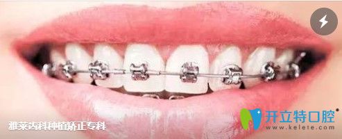 選擇杭州雅萊口腔做牙齒矯正的理由 選擇杭州雅萊口腔做牙齒矯正的理由