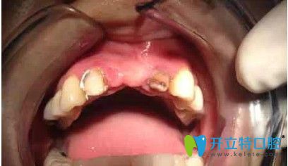 劉女士做種植牙前的照片