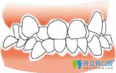 牙齒擁擠在正畸時(shí)就需要拔牙矯治