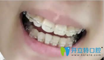 連江縣明輝口腔陶瓷托槽矯正案例圖