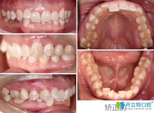 牙齒矯正前的照片