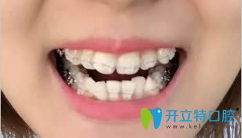 連江縣胡明輝口腔牙齒正畸術中照