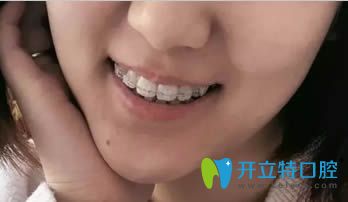 連江縣明輝口腔牙齒正畸18個月效果圖