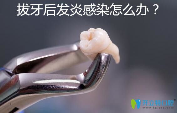 拔牙后發(fā)炎感染了怎么辦？感染癥狀有哪些你知道嗎？