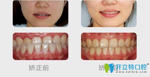 沈陽(yáng)盛大口腔青少年地包天案例效果