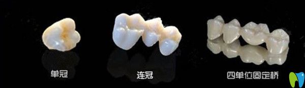 單冠、連冠、四單位固定橋區(qū)別