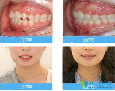 中山美南華牙科中心對(duì)刃頜矯正效果圖