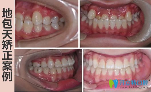 中山美南華地包天牙齒矯正前后對(duì)比照