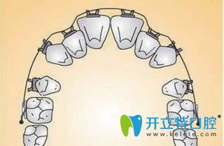 陶瓷牙套為什么容易掉?是因為陶瓷自鎖托槽太厚了?不盡然吧