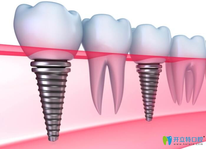 如何判斷種植牙是否成功