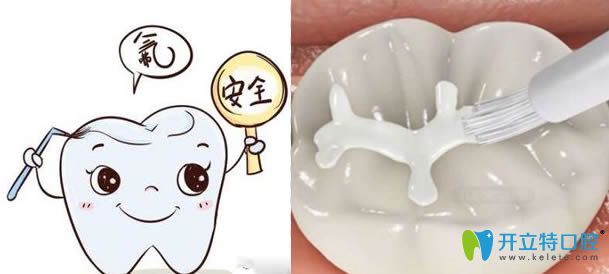 兒童防齲齒-做了窩溝封閉后還需要做涂氟嗎？能同時(shí)做嗎?