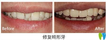 天津美奧口腔修復(fù)畸形牙齒對比圖