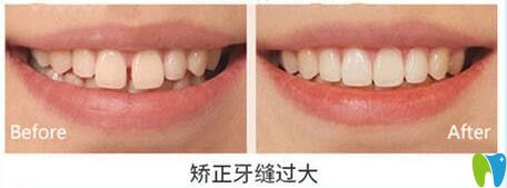 天津美奧口腔矯正牙縫過大效果圖
