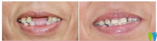 福州維樂口腔奧齒泰種植牙